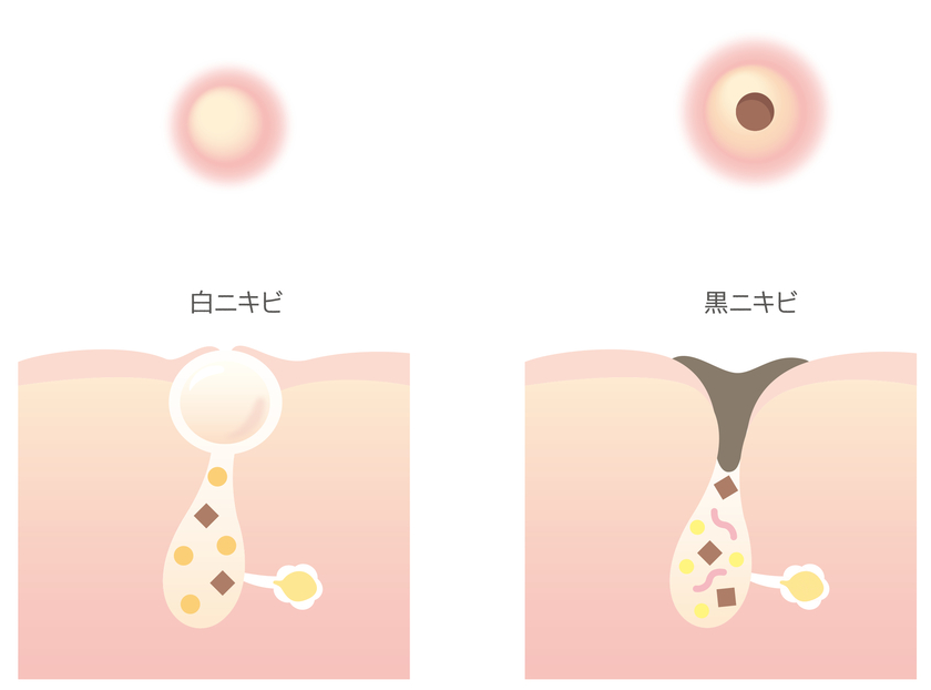 毛穴が詰まっている状態（白ニキビ・黒ニキビ）