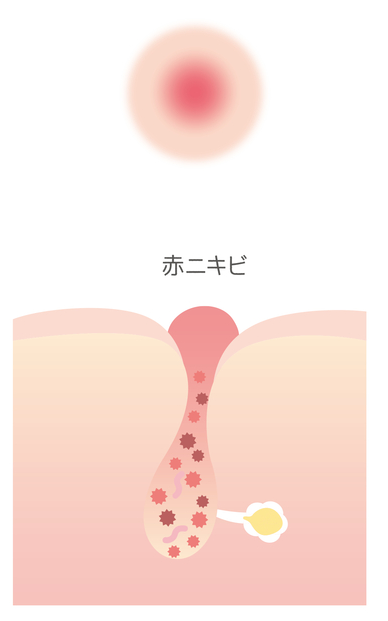 赤みがある炎症にきび（赤ニキビ）